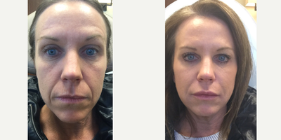 Restylane Lyft before and after photo