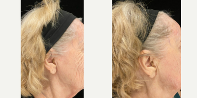 Skin Tightening before and after photo