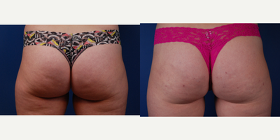 Cellfina before and after photo