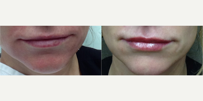 Lip Fillers before and after photo