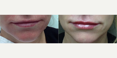 Lip Fillers before and after photo