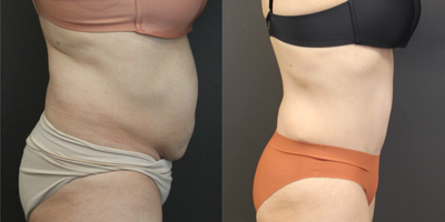 Tummy Tuck before and after photo