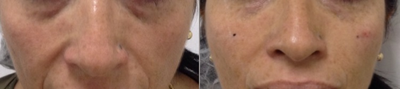 Voluma before and after photo