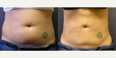 CoolSculpting before and after photo