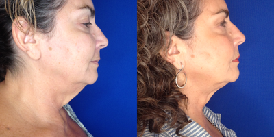 FaceTite before and after photo