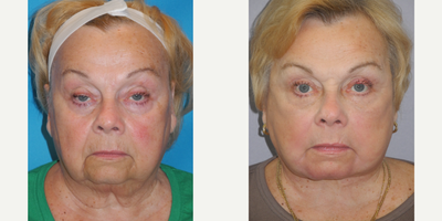 Facial Fat Transfer before and after photo