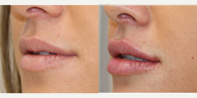 Lip Fillers before and after photo