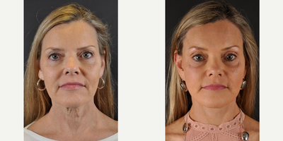 Mini Facelift before and after photo