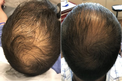 PRP for Hair Loss before and after photo