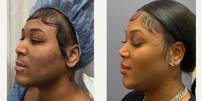 Septoplasty before and after photo