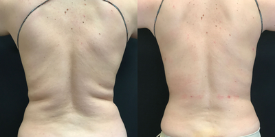 Vaser Liposuction before and after photo