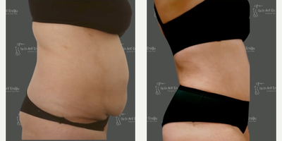 Body Lift before and after photo