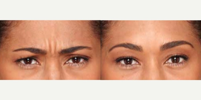 Botox before and after photo