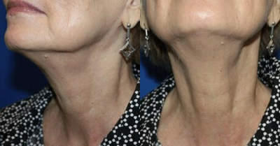 CO2 Laser before and after photo