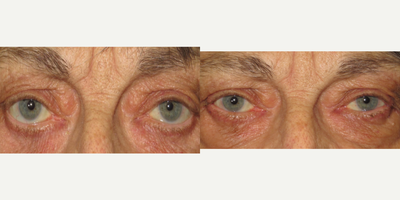 Eyelid Retraction Repair before and after photo
