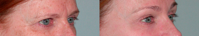 Eyelid Surgery before and after photo