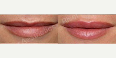 Lip Fillers before and after photo
