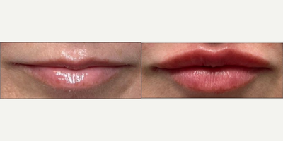 Lip Fillers before and after photo