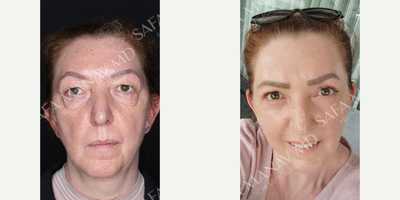 Rhinoplasty before and after photo