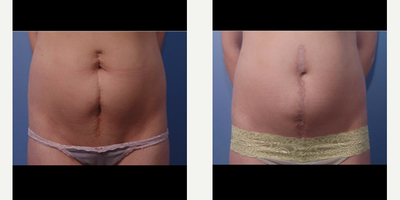 Scar Removal before and after photo