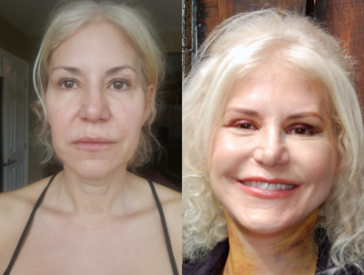 SMAS Facelift before and after photo