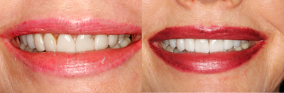 Smile Makeover before and after photo