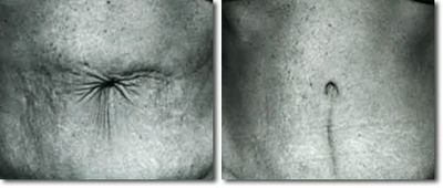 Tummy Tuck before and after photo