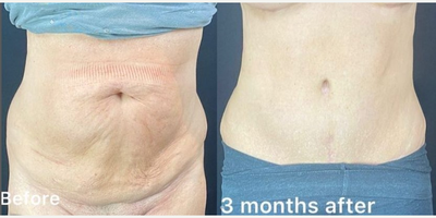Tummy Tuck before and after photo