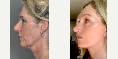 Facelift before and after photo