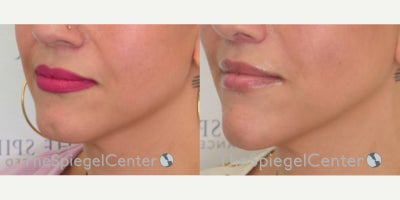 Lip Lift before and after photo