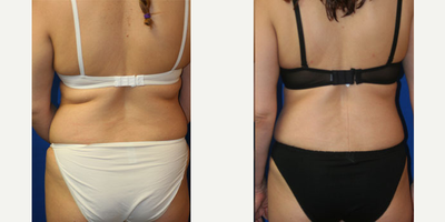 Liposuction before and after photo