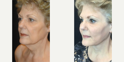 Neck Lift before and after photo