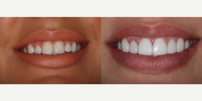 Porcelain Veneers before and after photo