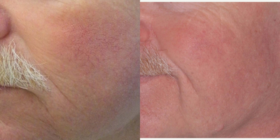 Sclerotherapy before and after photo