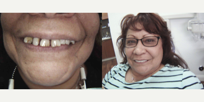 Smile Makeover before and after photo