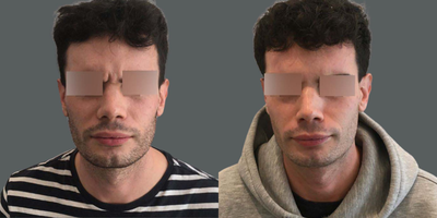 Botox before and after photo