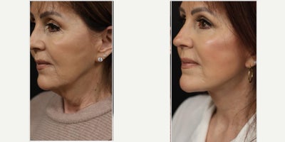 Facelift before and after photo