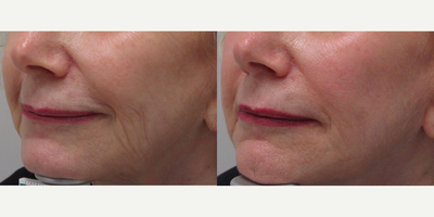 Profound RF before and after photo