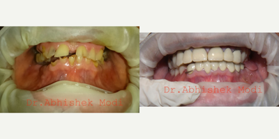 Smile Makeover before and after photo