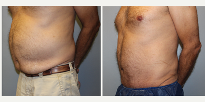 Tummy Tuck before and after photo