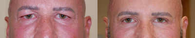 Eyelid Surgery before and after photo