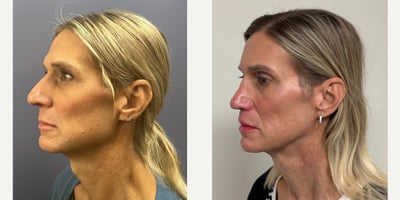 Forehead Reduction before and after photo