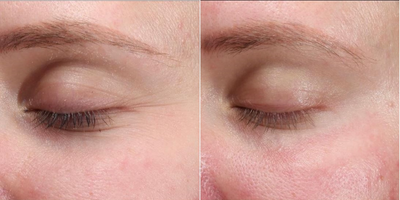 Halo Laser before and after photo