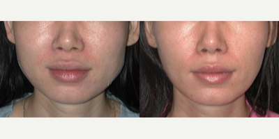 Botox for TMJ before and after photo