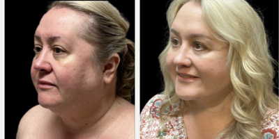 Facelift before and after photo