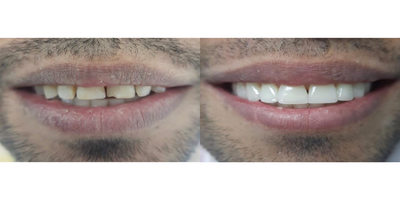 Porcelain Veneers before and after photo