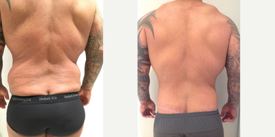 Body Lift before and after photo