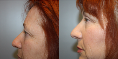 Eyelid Surgery before and after photo