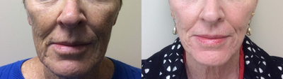 Halo Laser before and after photo