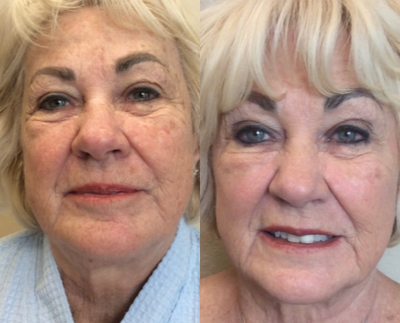 Halo Laser before and after photo